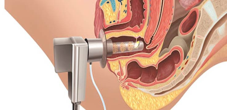 Short Time Efficacy and Safety of Focused Monopolar Radiofrequency Device for Labial Laxity Improvement